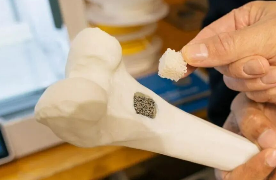 3D打印加工正產生個性化醫療零件革命
